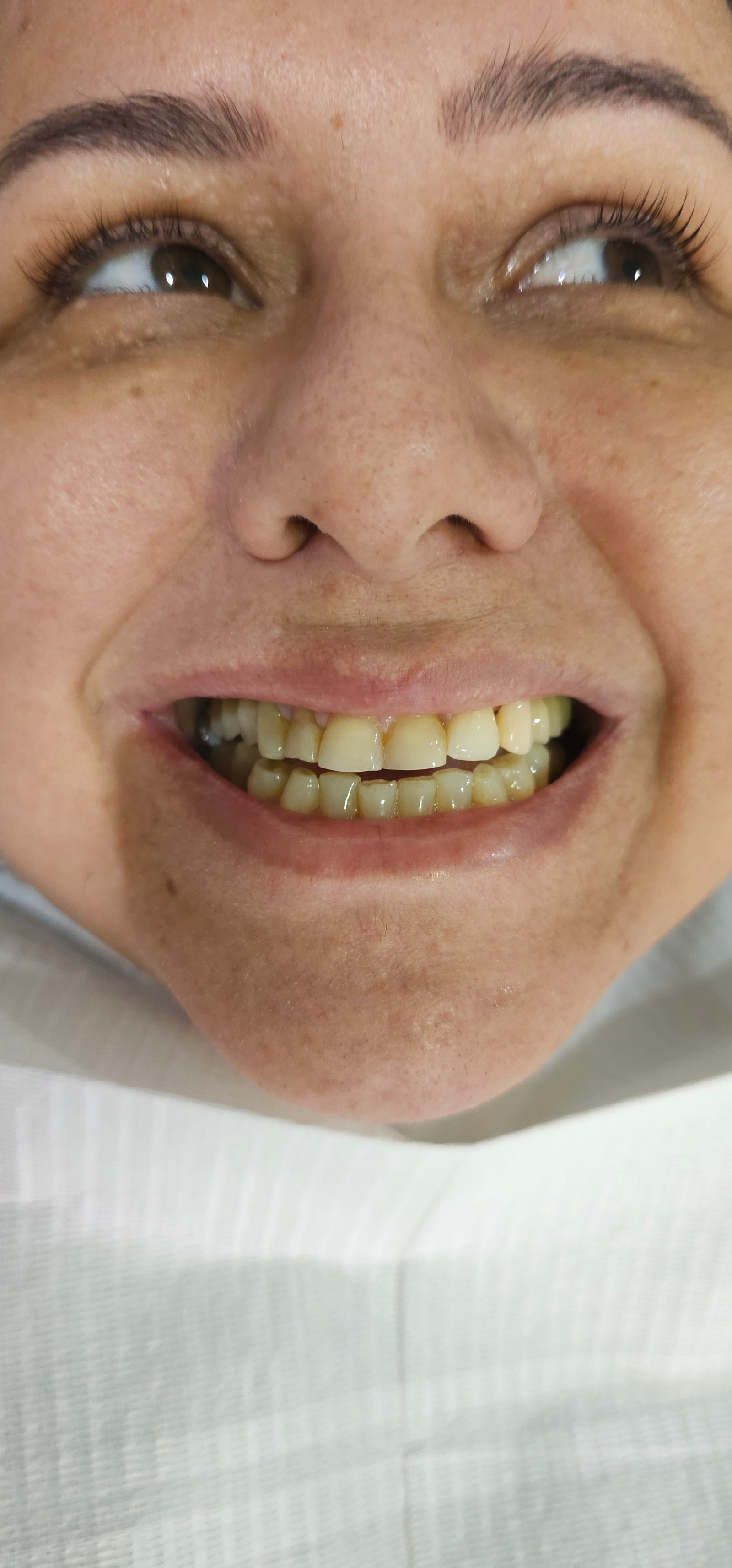 Antes do tratamento - Implante dental