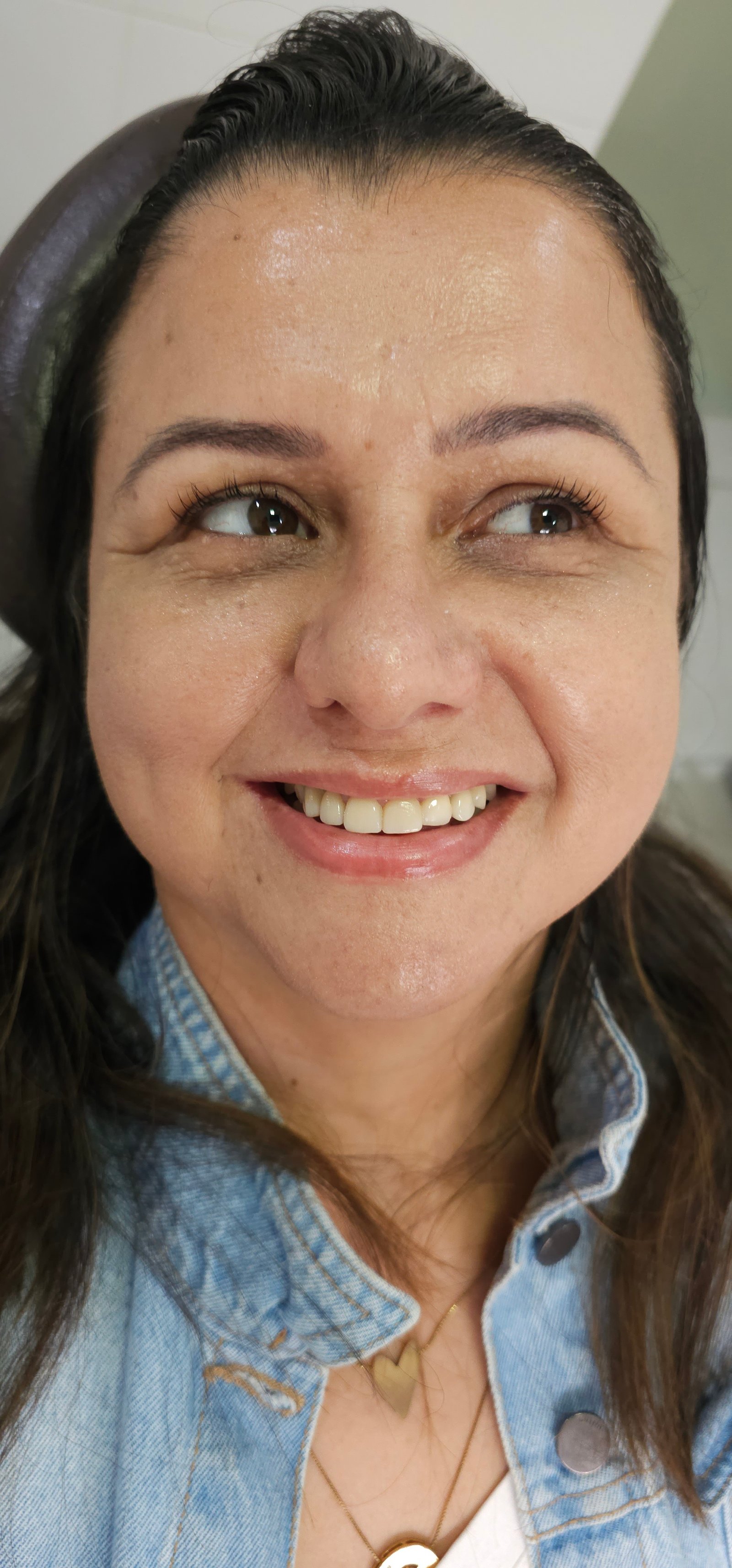 Depois do tratamento - Implante dental